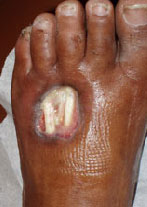 Foot Ulcer