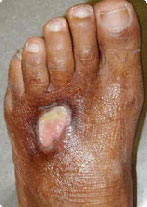 Foot Ulcer