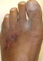 Foot Ulcer