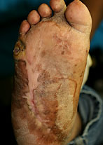 Foot Ulcer