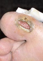 Foot Ulcer