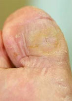 Foot Ulcer