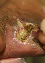 Foot Ulcer