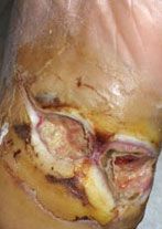 Foot Ulcer