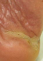 Foot Ulcer