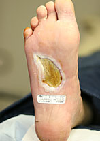 Foot Ulcer