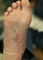 Foot Ulcer