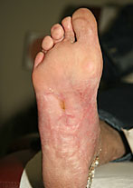 Foot Ulcer